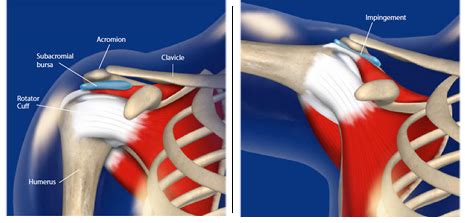 Arthroscopic Subacromial Decompression