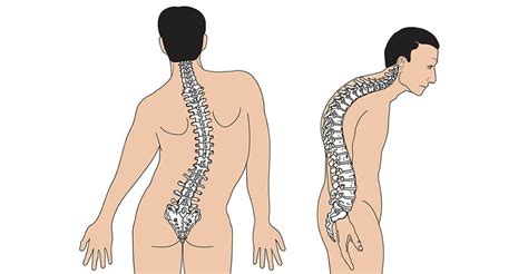 Escoliosis Causas S Ntomas Y Tratamientos Salud Net Ar