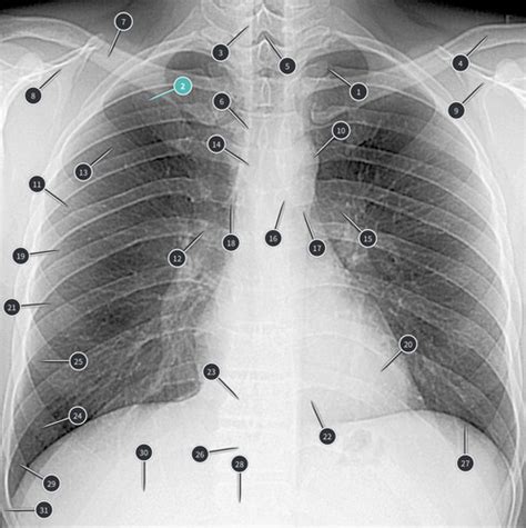 Normal Chest X Ray Flashcards Quizlet