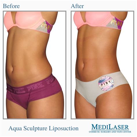 Liposuction Before And After Medilaser Surgery And Vein Center