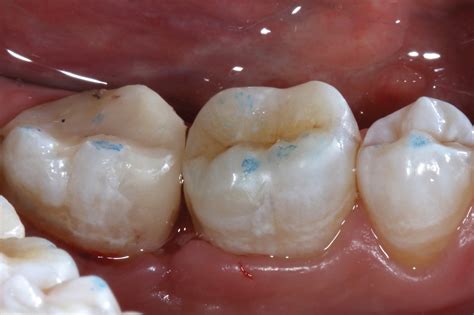 A Cadcam Fabricated Aesthetic Onlay Case Dentistry