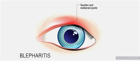 Blepharitis Al Manal Eye Hospital