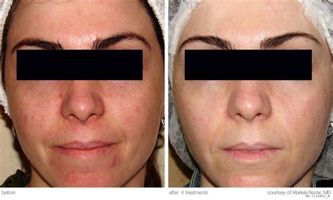 Is There Any Difference Between Laser Vs Ipl For Rosacea