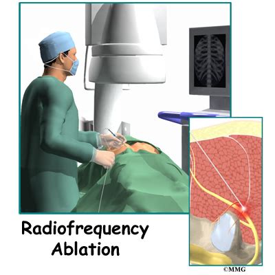 Radiofrequency Ablation Midwest Bone And Joint Institute Illinois