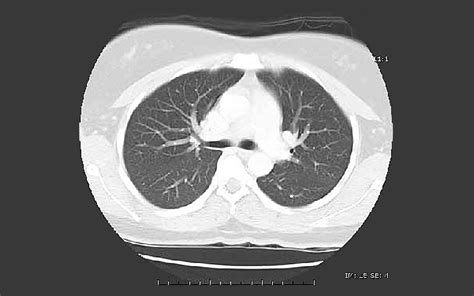 Invasive Ductal Carcinoma Stage 1