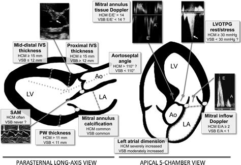 Distinguishing Ventricular Septal Bulge Versus Hypertrophic Cardiomyopathy In The Elderly Heart