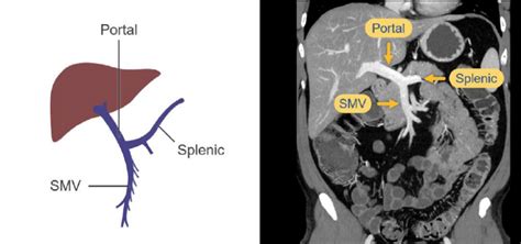 Abdominal Ct Abdominal Veins • Litfl • Radiology Library