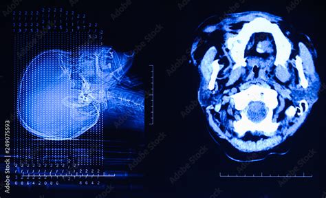 Mri Of The Brain X Ray Film Of The Brain Computed Tomography On Back