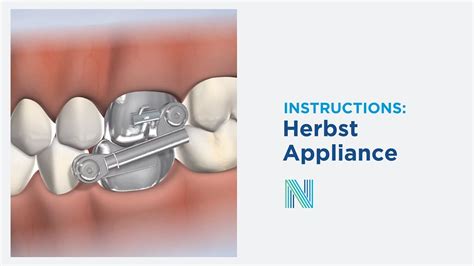 Herbst Appliance Instructions In Fresno Ca Nalchajian Orthodontics