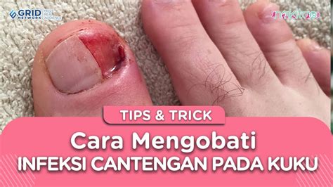 Wah Ternyata Begini Lho Cara Mengobati Infeksi Cantengan Pada Kuku