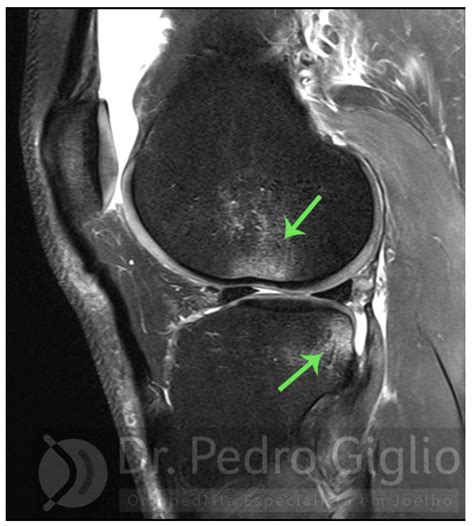 Edema Ósseo Do Joelho Dr Pedro Giglio