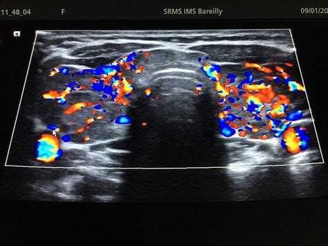 75 Tirads ideas | ultrasound, thyroid, sonography