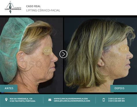 Real Case Cervico Facial Lift Clínica Luso Espanhola Cirurgia