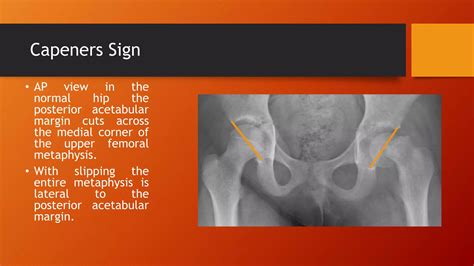 Slipped Capital Femoral Epiphysis Ppt