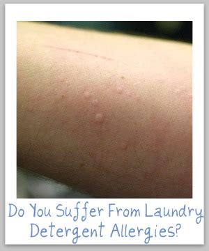 Skin Rash From Detergent - Allergic to Detergent? *PICS* - BabyCenter ...