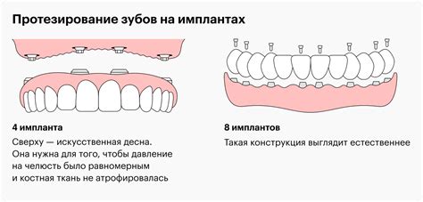 13 важных вопросов об имплантации зубов