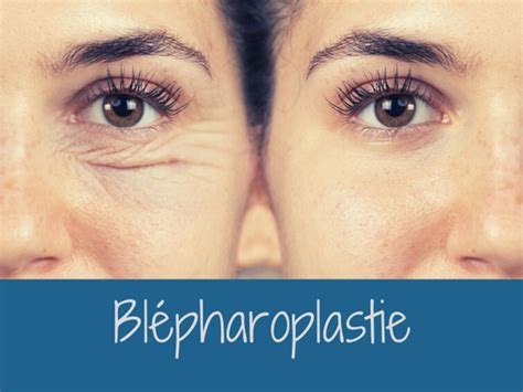 Qu est ce que la blépharoplastie supérieure et inférieure