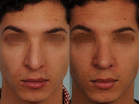 Rhinoplastie Avant Apr S Photos Et Exemples De Nez Refaits