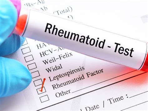 Romatoid Fakt R Hangi Hastal Klarda Y Kselir Soruyeri Ile Arad N