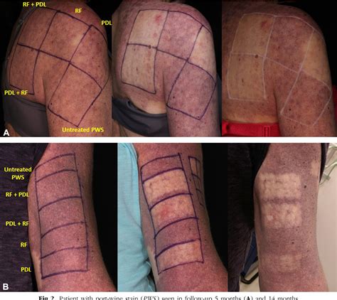 Figure 1 From Treatment Of Recalcitrant Port‐wine Stains Pws Using A Combined Pulsed Dye Laser