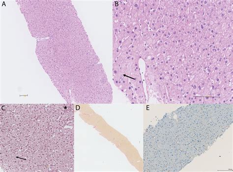 Nodular Regenerative Hyperplasia