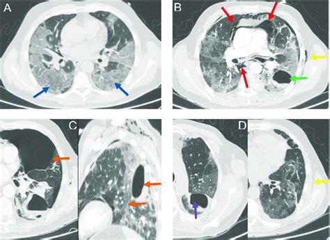 A Chest Ct Showing Bilateral Ground Glass Opacities Blue Arrow On