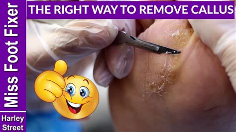 The Right Way To Remove Callus And Corns Full Treatment Youtube