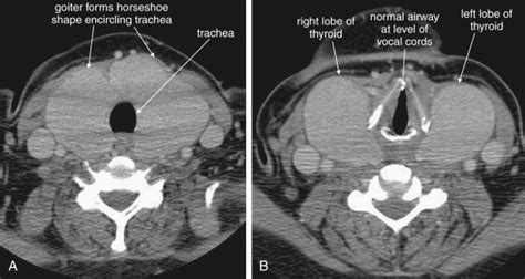 Imaging Soft Tissues Of The Neck Radiology Key