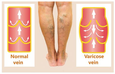 Varicose Veins Symptoms Chicago Vein And Vascular Center