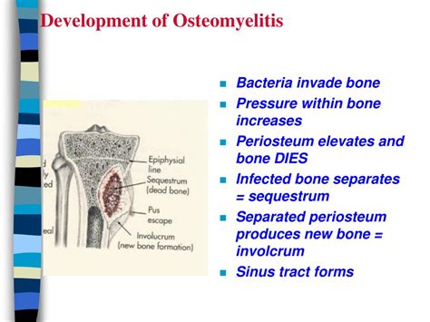 Ppt Osteomyelitis Powerpoint Presentation Free Download Id298370