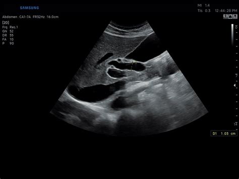 Ultrasound Images Liver B Mode Echogramm №802