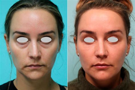 Tear Trough / Under Eye Injections before and after photos - The Naderi ...