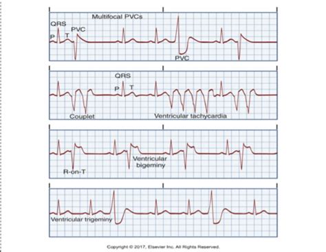 Ekg Flashcards Quizlet
