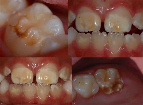 Hipoplasia Del Esmalte En Ni Os Y Adultos Gu A