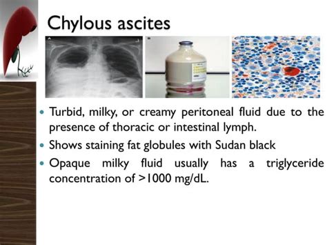 Diagnosis and Treatment of Ascites | PPT