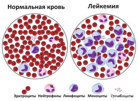 Недифференцированный (острый) лейкоз