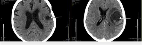 Ct Scan In November Showing Cr In Brain Left Comparing To The