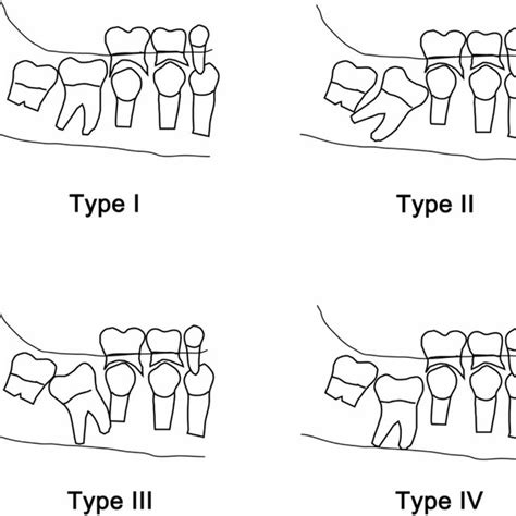 Classification Of Retention Types Of The First Permanent Molars Of The Download Scientific