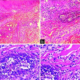 Estudio Histopatol Gico E Inmunohistoqu Mico Visi N Pan Ramica De La