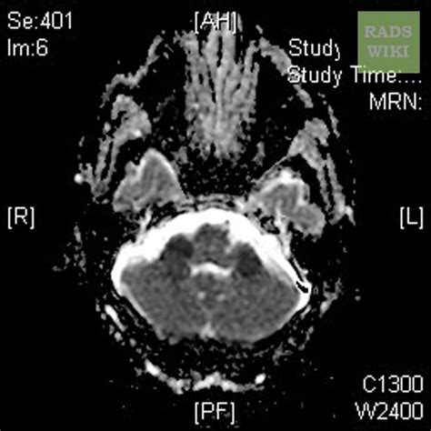 Ischemic stroke MRI - wikidoc