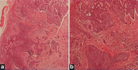 Xeroderma Pigmentosum Histology