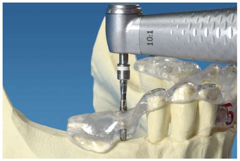 Dentistry Journal Free Full Text The Use Of Orientation Templates And Free Hand Implant