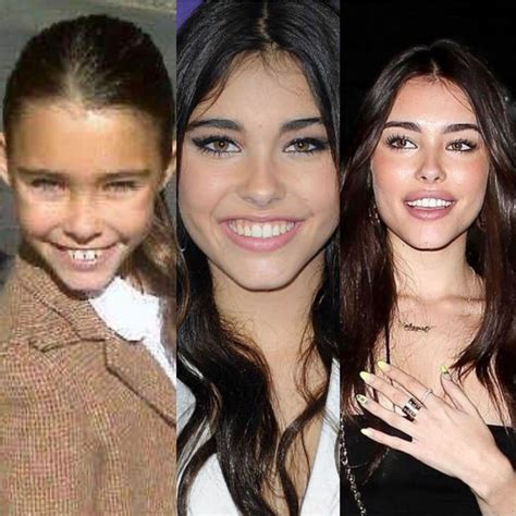 Facial Fillers Lip Fillers Madison Beer Plastic Surgery Pretty Nose