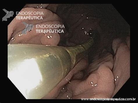 Quais As Possíveis Complicações Da Gastrostomia - Complicações de gastrostomia • Endoscopy News