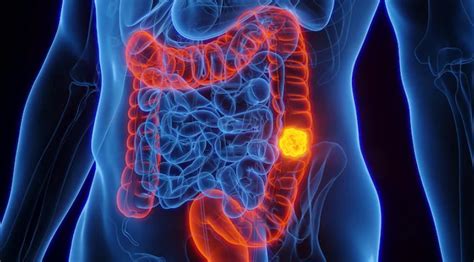 Servicio De Noticias En Salud Al Día Aumenta Cáncer Intestinal En