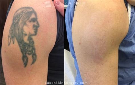 Surgical Tattoo Removal Before And After Kazuko Gilliland