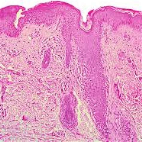 Histological Examination Of The Maculopapular Skin Lesion Showing