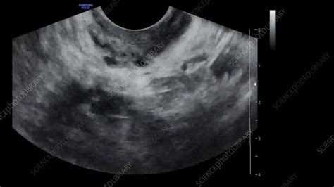 Ovarian Follicle Ultrasound