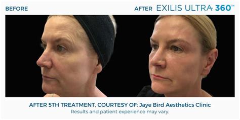 Exilis Ultra El Paso Exilis Skin Tightening Treatments