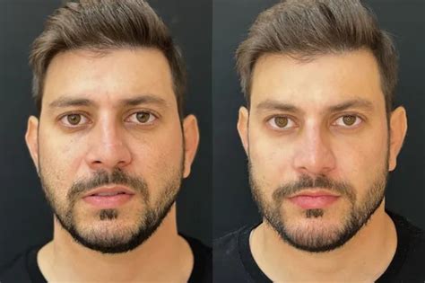 Ex Bbb Caio Afiune Faz Harmoniza O Facial Veja Antes E Depois Hugo